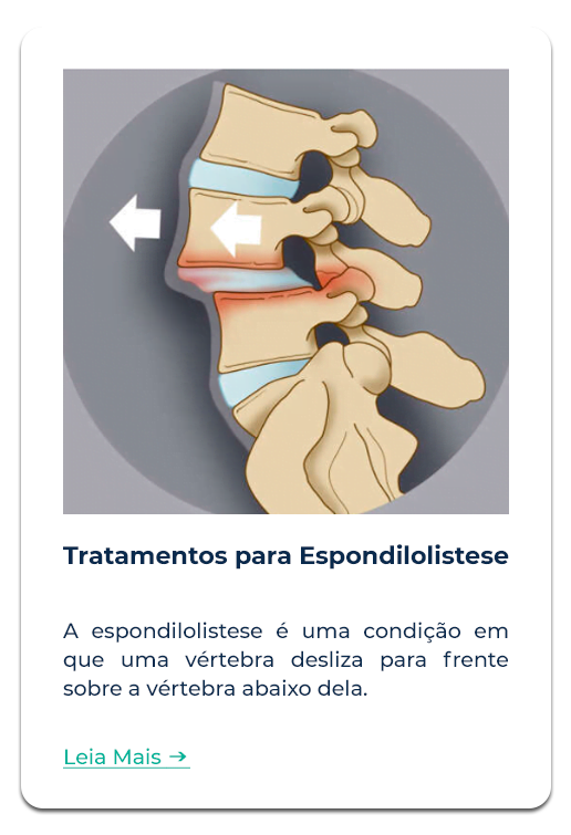 Tratamento Espondilolistese